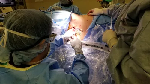 Dr. Shakir performs the first single position lateral approach for hardware removal and fusion extension/revision surgery